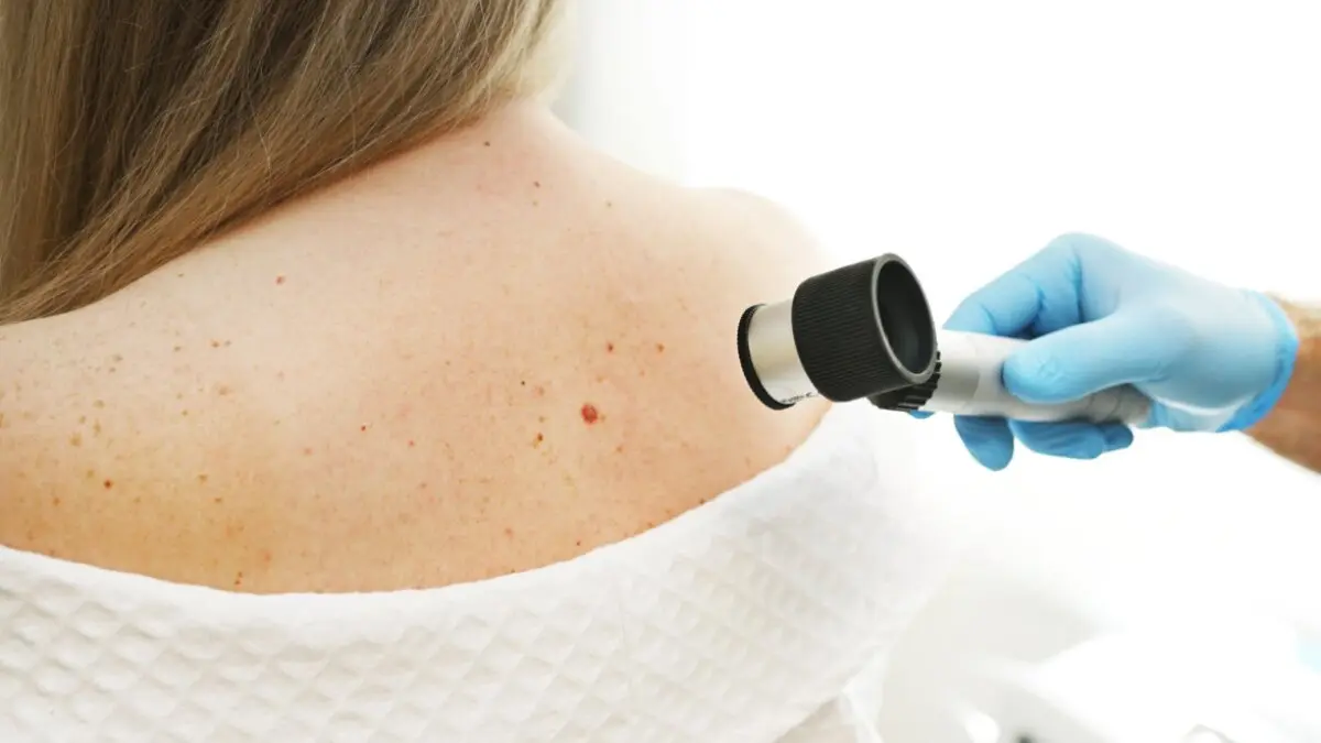 Melanoma